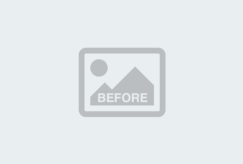 Before Image: Labiaplasty - front