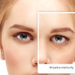 Eyelid Lift (Blepharoplasty) Bloomington