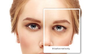 Eyelid Lift (Blepharoplasty) Bloomington