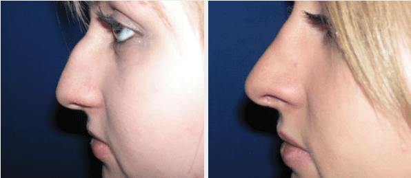 Before & After Rhinoplasty
