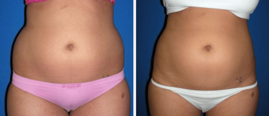 Before and after results of Liposuction