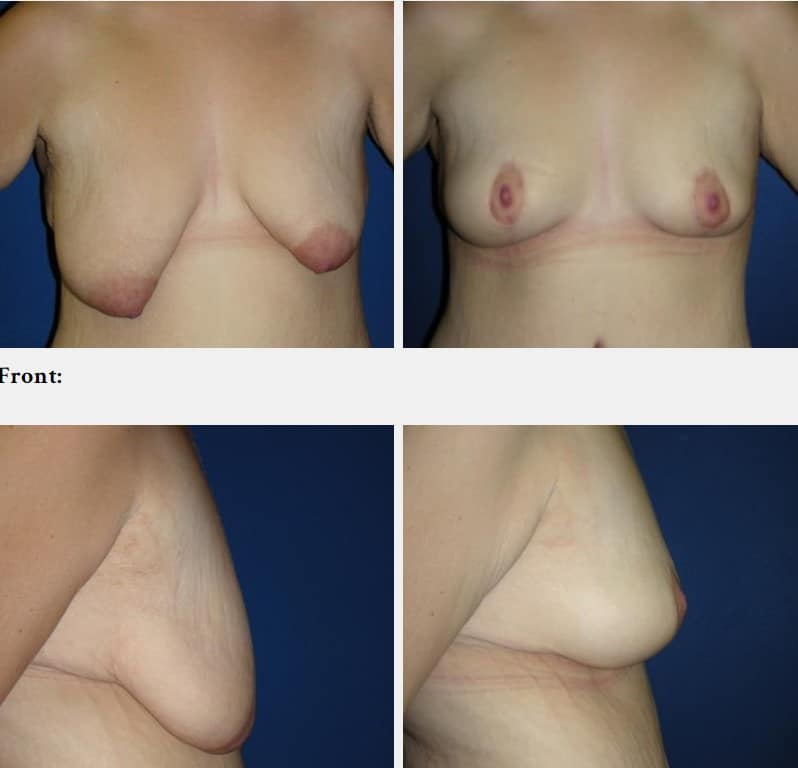 breast lift