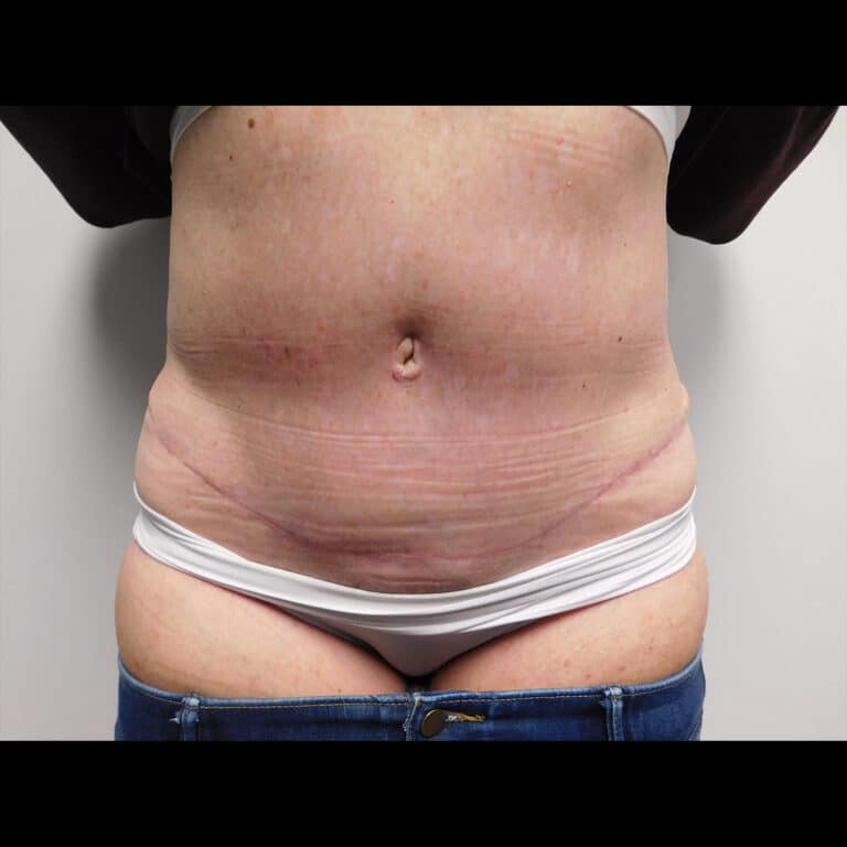 After Image: Abdominoplasty - front