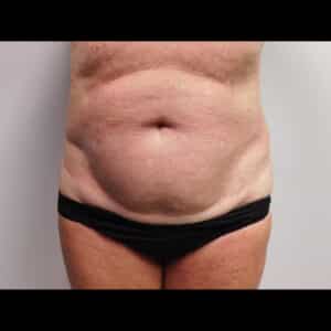 Before Image: Abdominoplasty