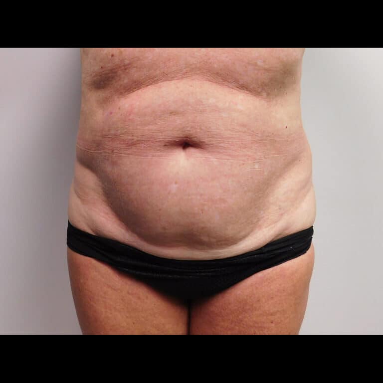 Before Image: Abdominoplasty - front