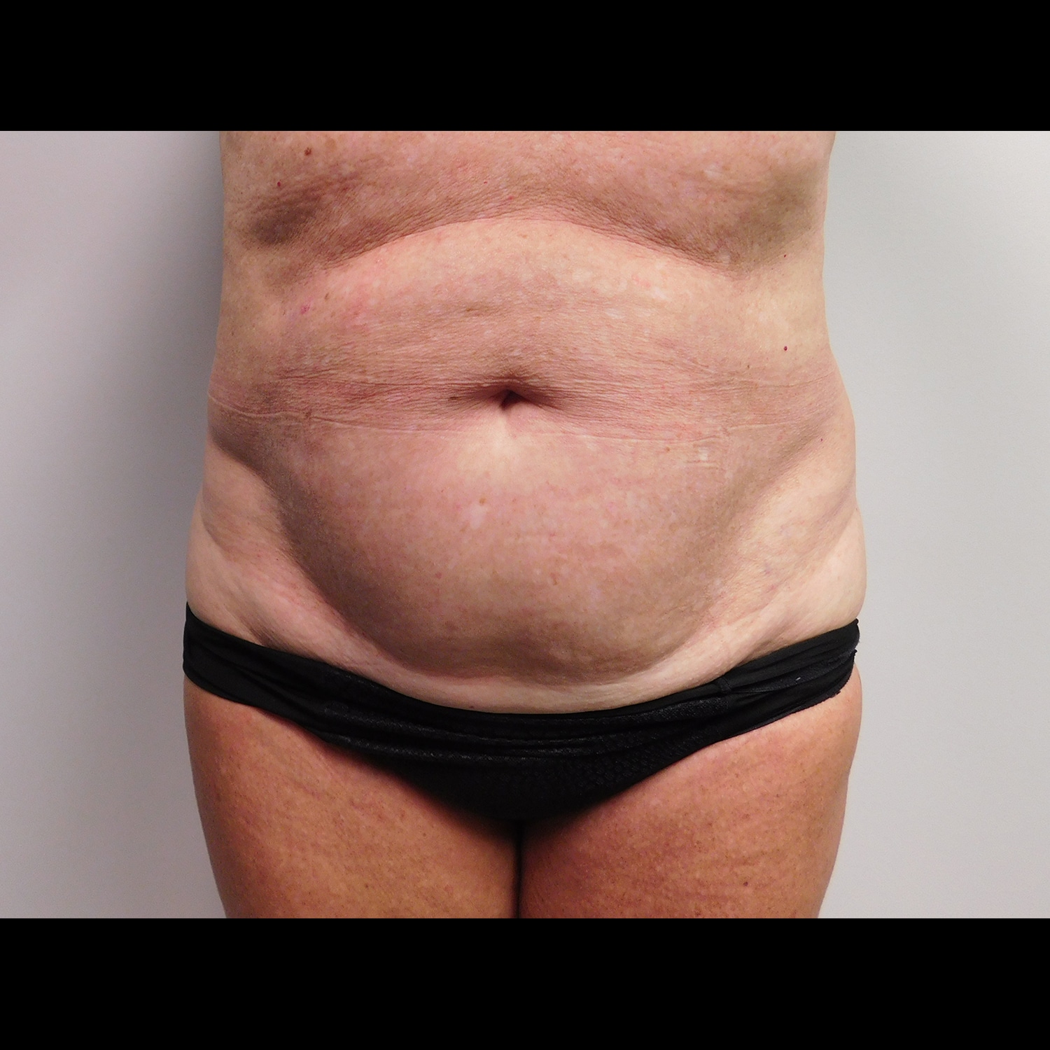 Before Image: Abdominoplasty - front