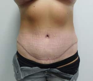 After Image: Abdominoplasty