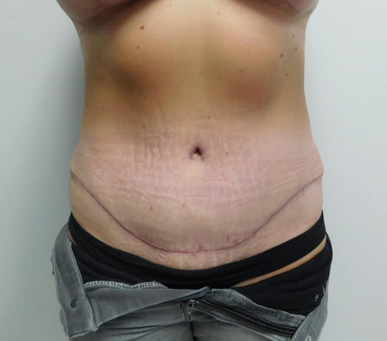 After Image: Abdominoplasty - front