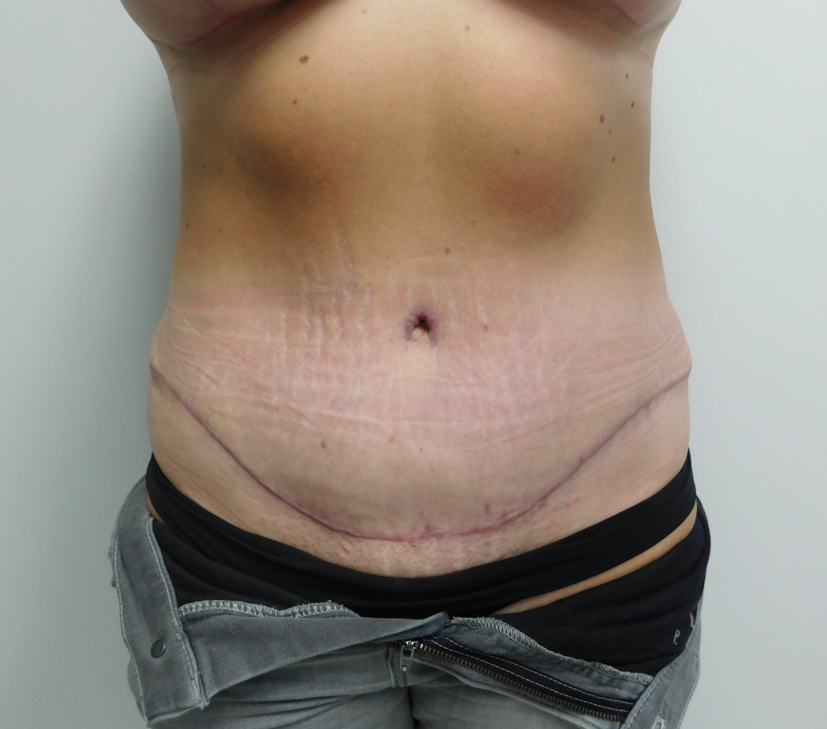 After Image: Abdominoplasty - front