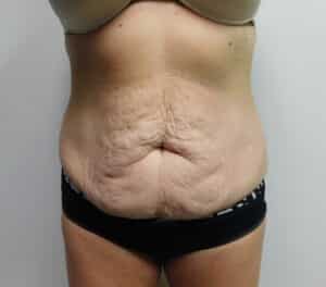 Before Image: Abdominoplasty