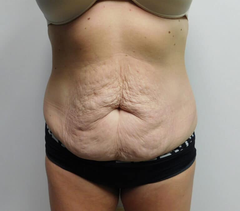 Before Image: Abdominoplasty - front