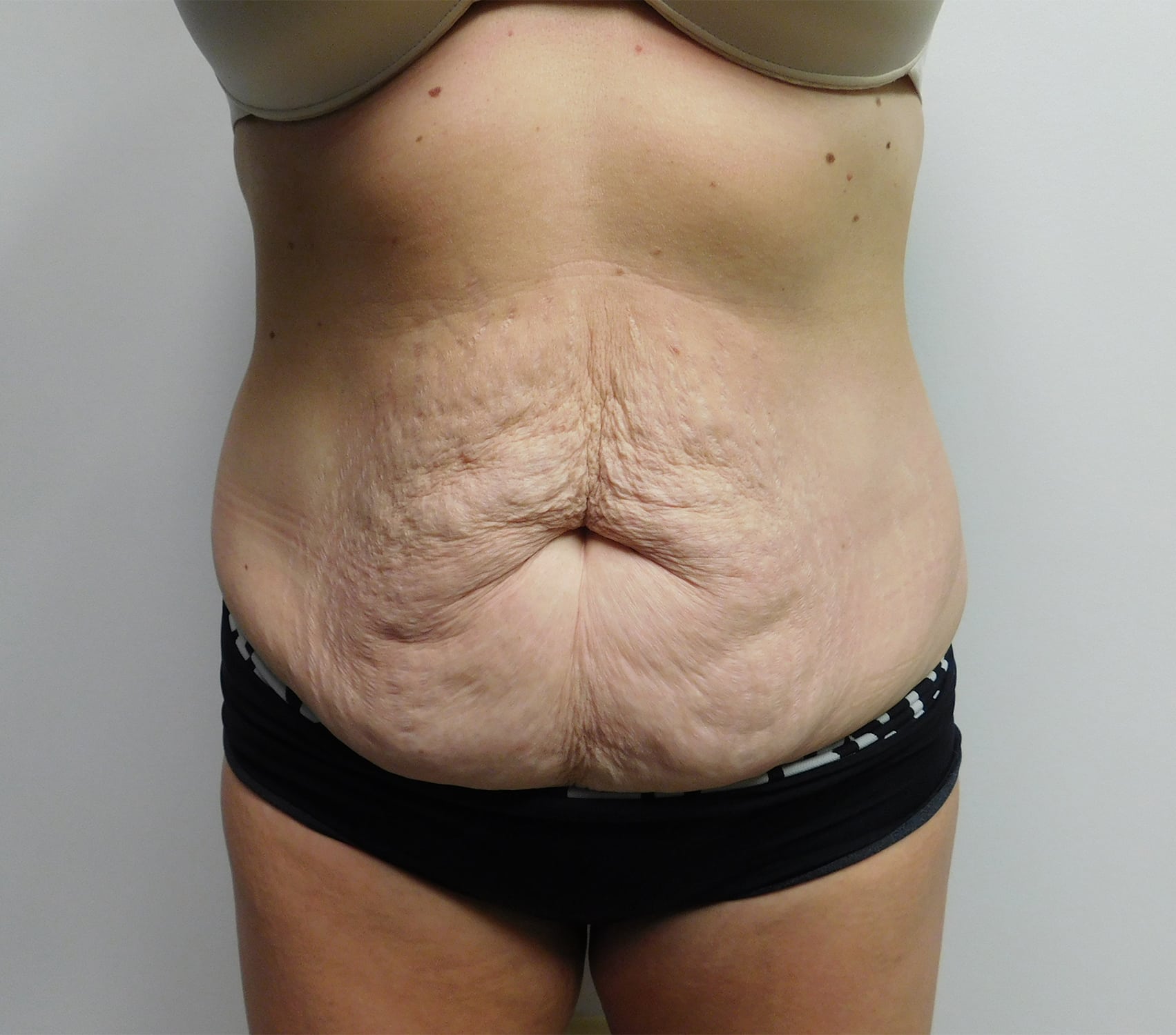 Before Image: Abdominoplasty - front