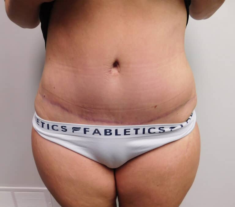 After Image: Abdominoplasty - front