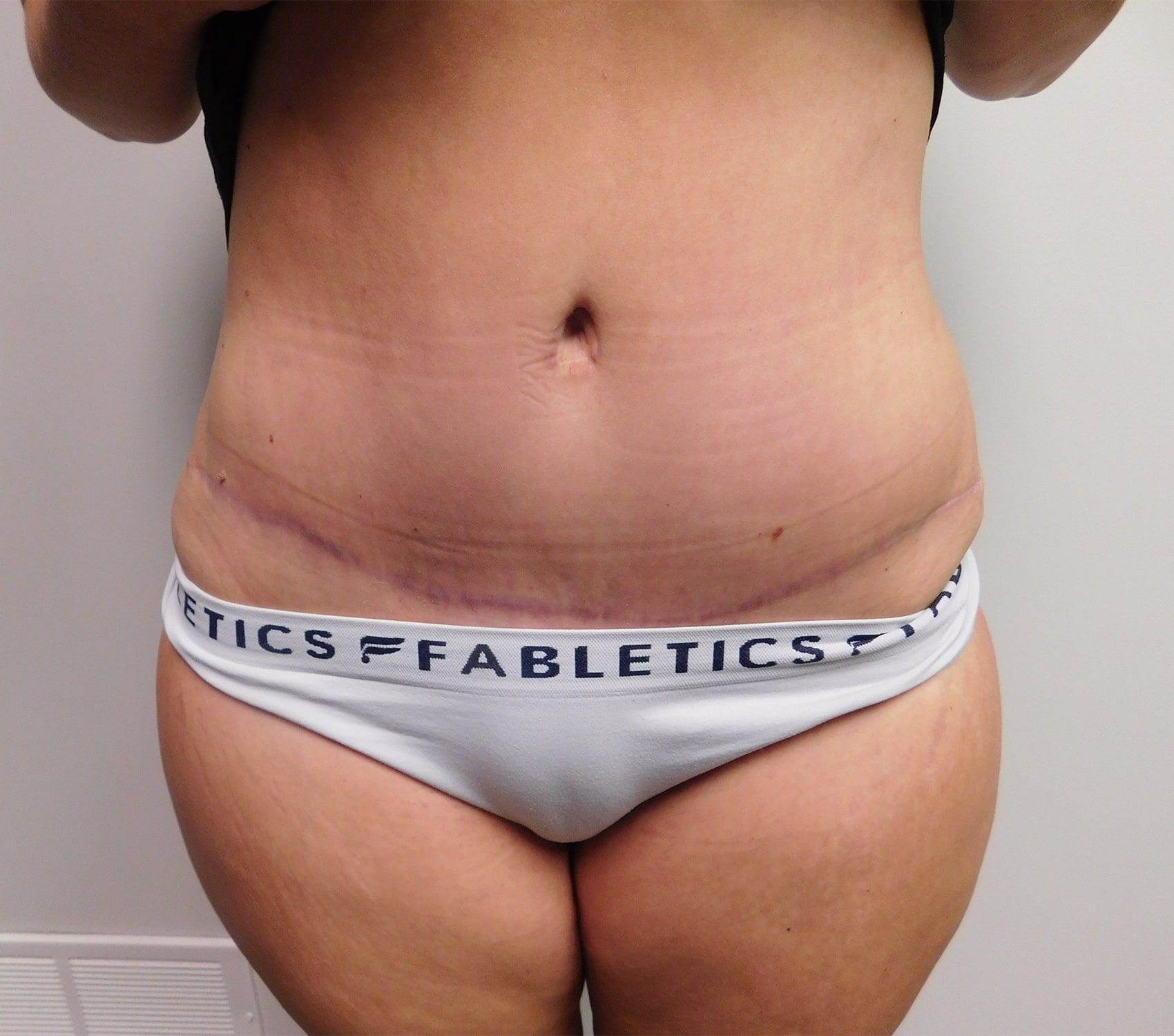 After Image: Abdominoplasty - front