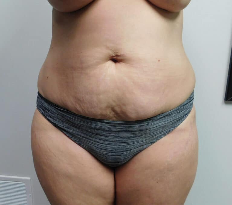 Before Image: Abdominoplasty - front