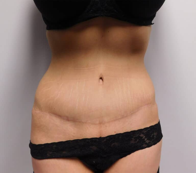 After Image: Abdominoplasty - front
