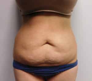 Before Image: Abdominoplasty