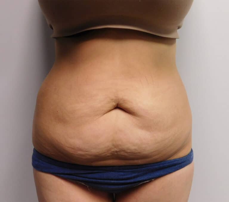 Before Image: Abdominoplasty - front