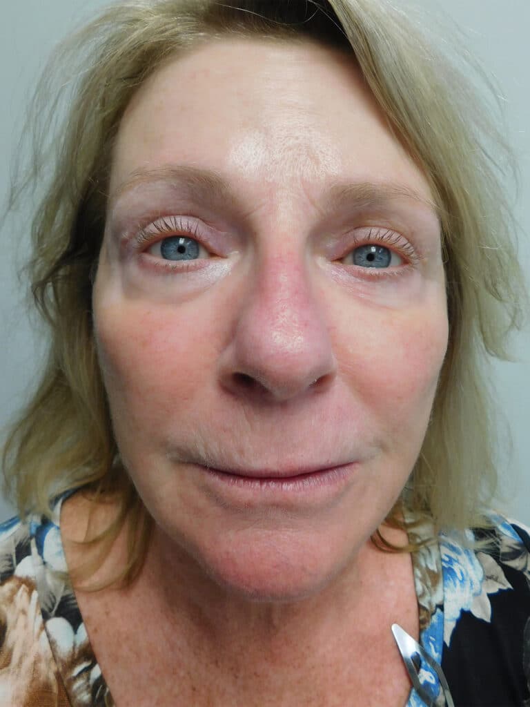After Image: Facelift - front