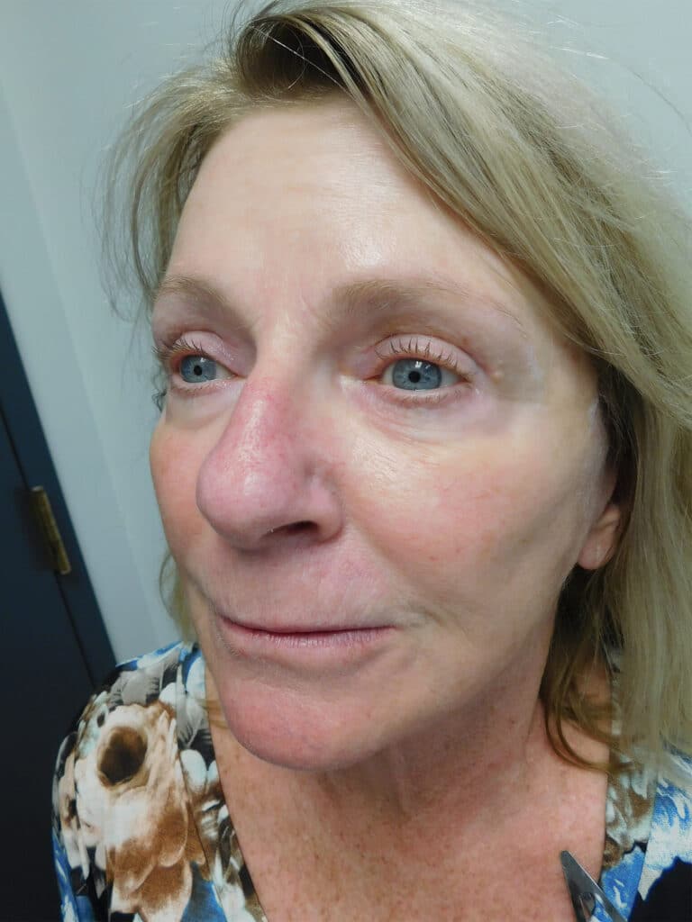 After Image: Facelift - left-front-oblique