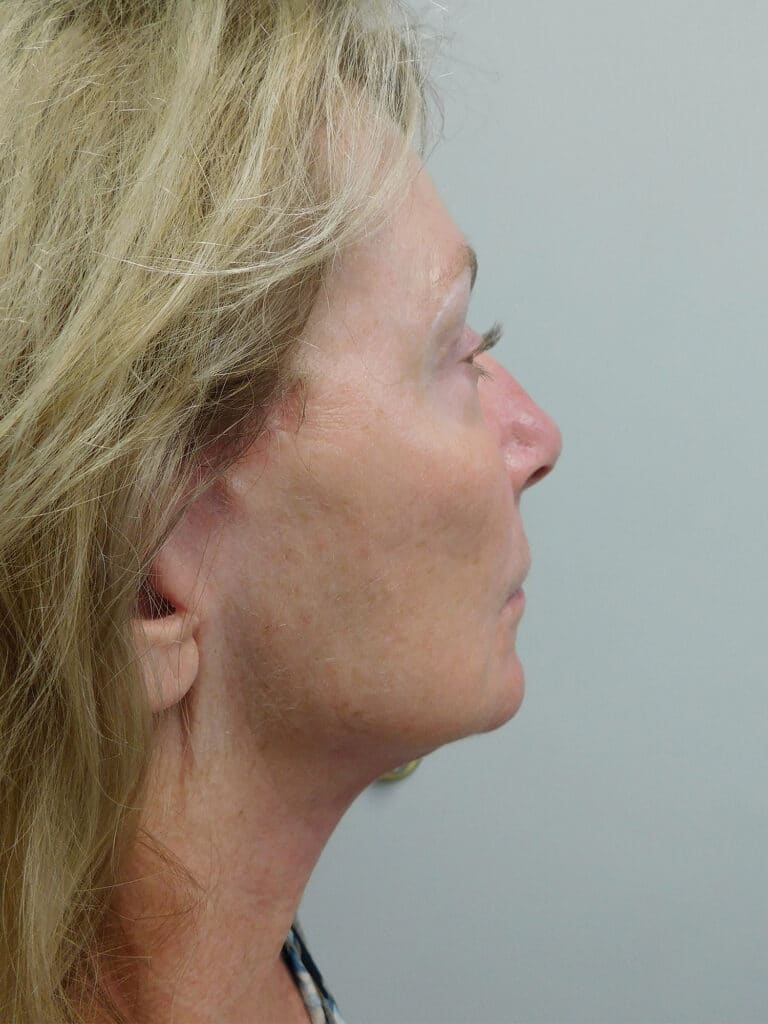 After Image: Facelift - right-side