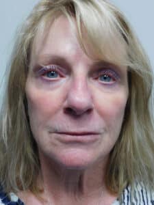 Before Image: Facelift