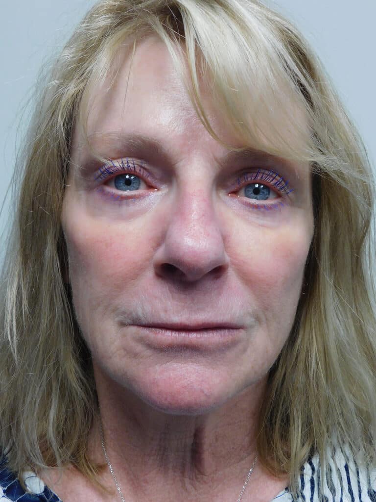 Before Image: Facelift - front