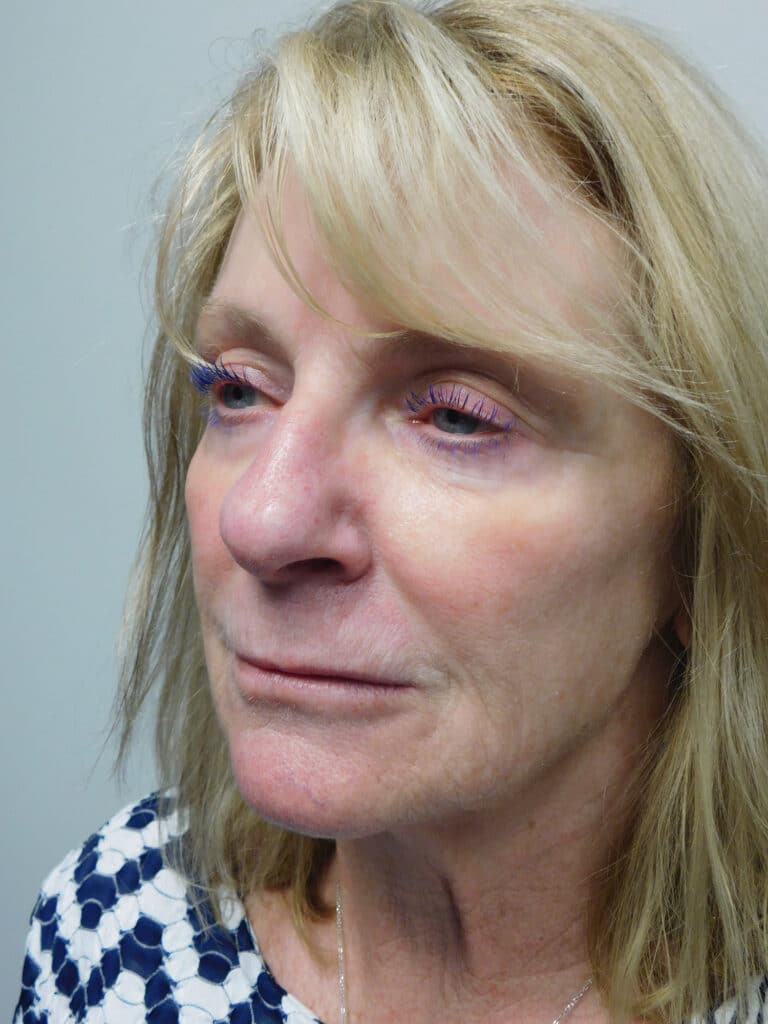 Before Image: Facelift - left-front-oblique