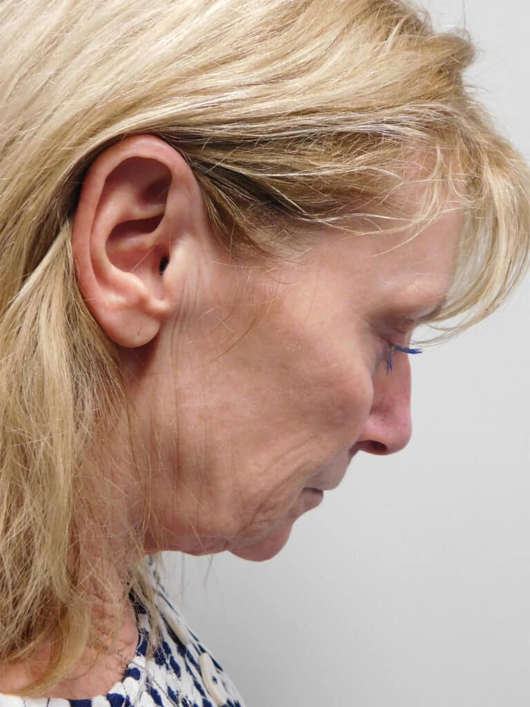 Before Image: Facelift - right-side