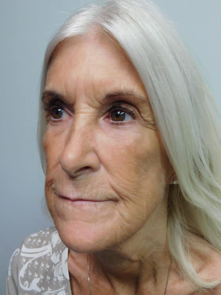 Before Image: Facelift - left-front-oblique
