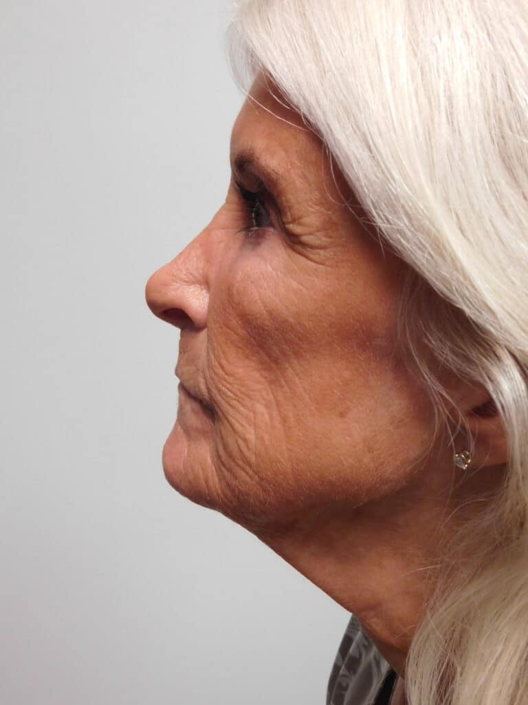 Before Image: Facelift - left-side