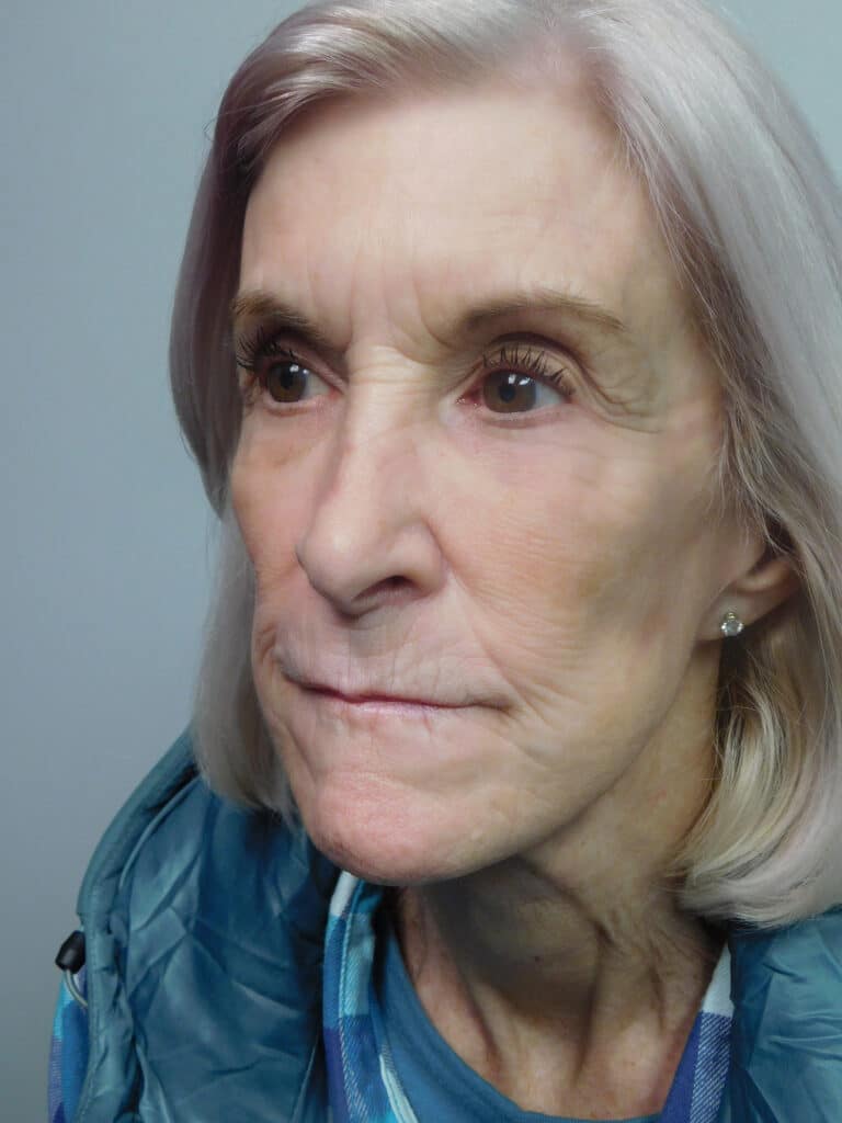 After Image: Facelift - left-front-oblique