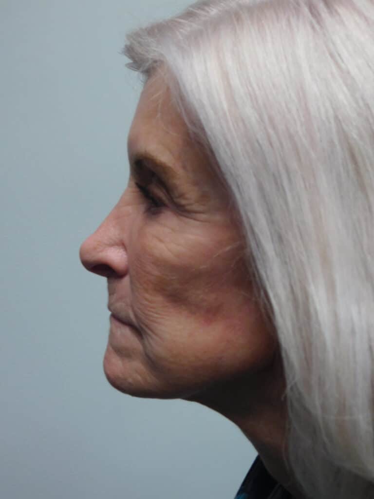 After Image: Facelift - left-side