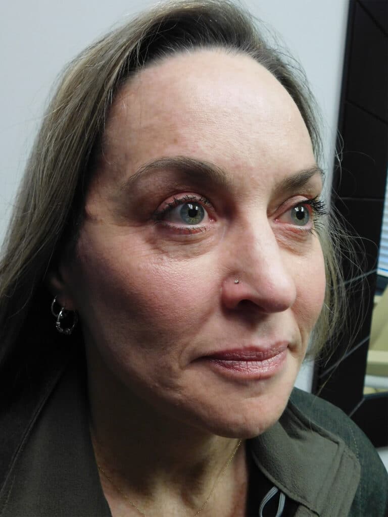 After Image: Facelift - right-front-oblique