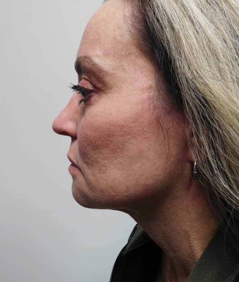 After Image: Facelift - left-side