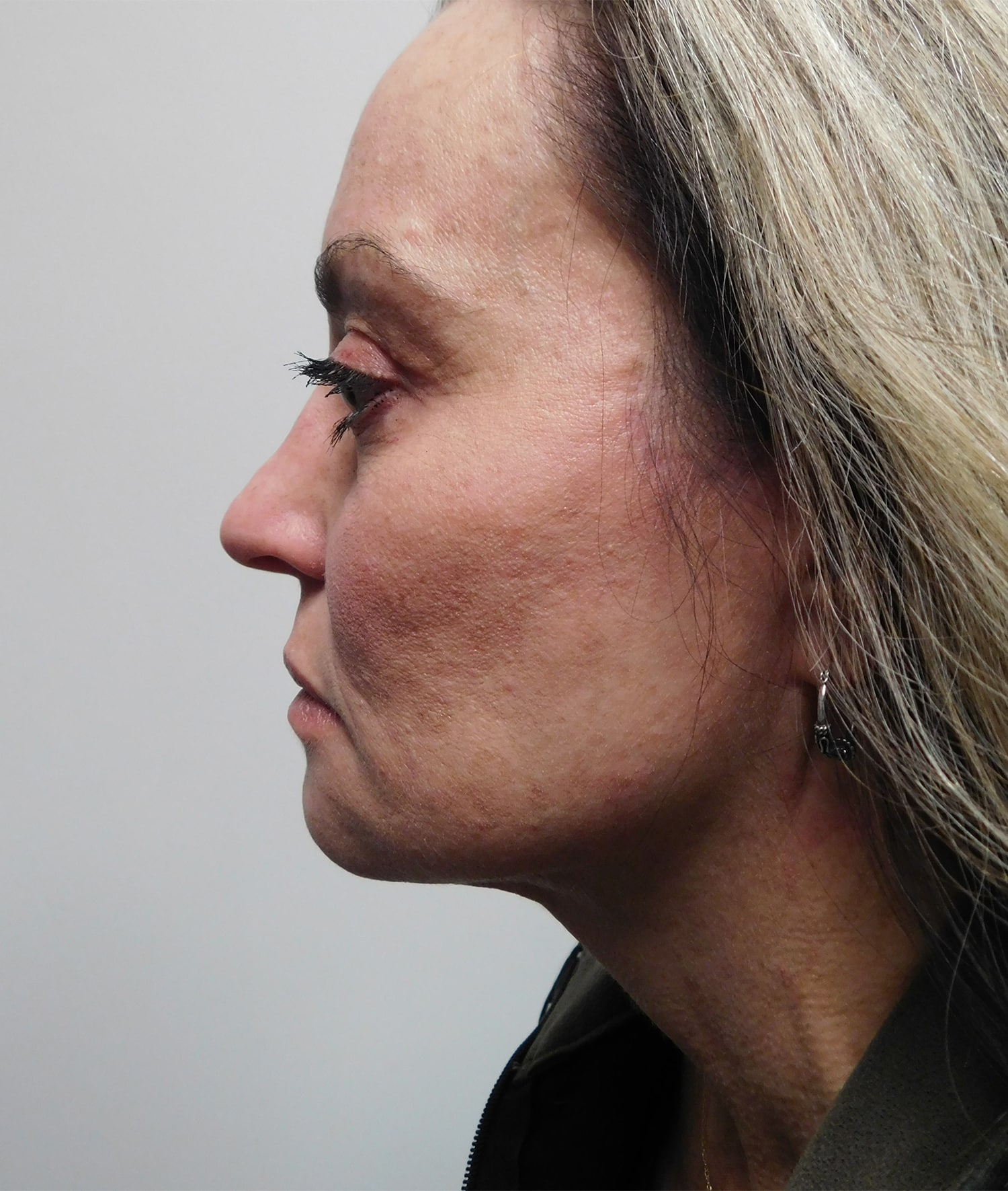 After Image: Facelift - left-side