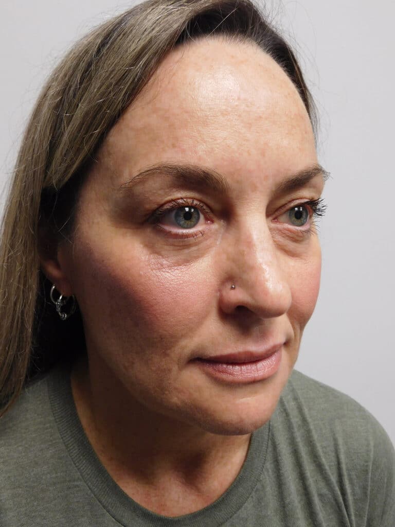Before Image: Facelift - right-front-oblique
