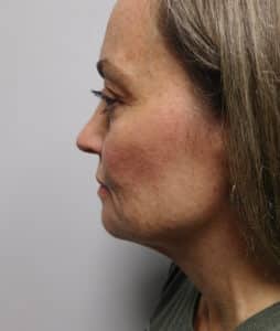 Before Image: Facelift