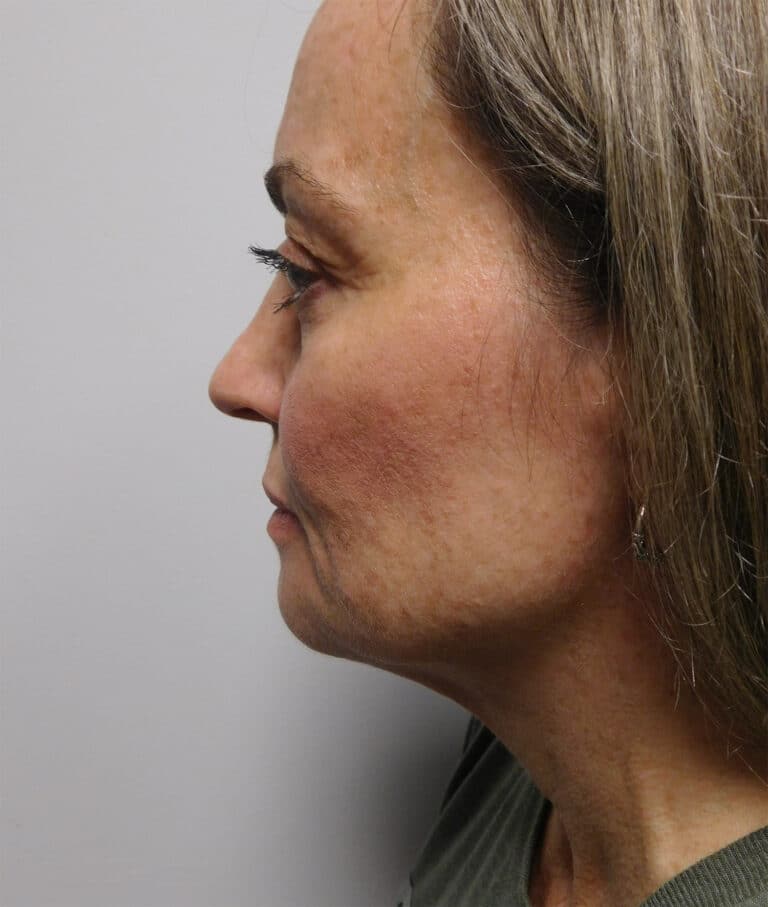 Before Image: Facelift - left-side