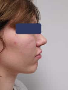 After Image: Chin Augmentation