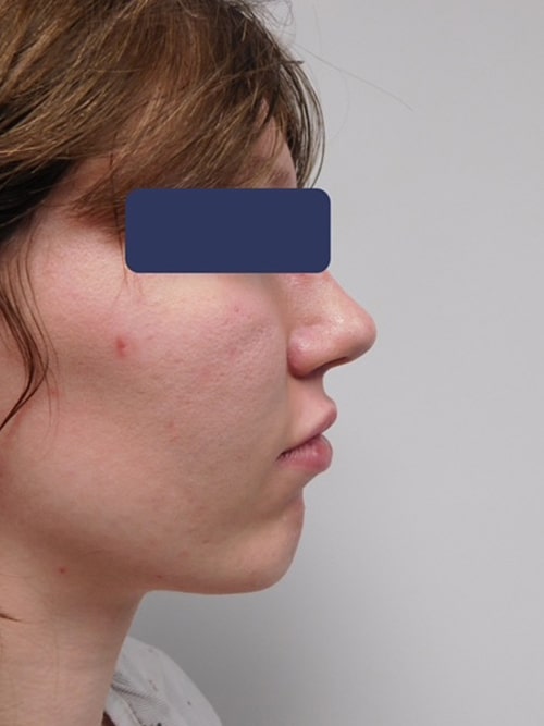 After Image: Chin Augmentation - right-side