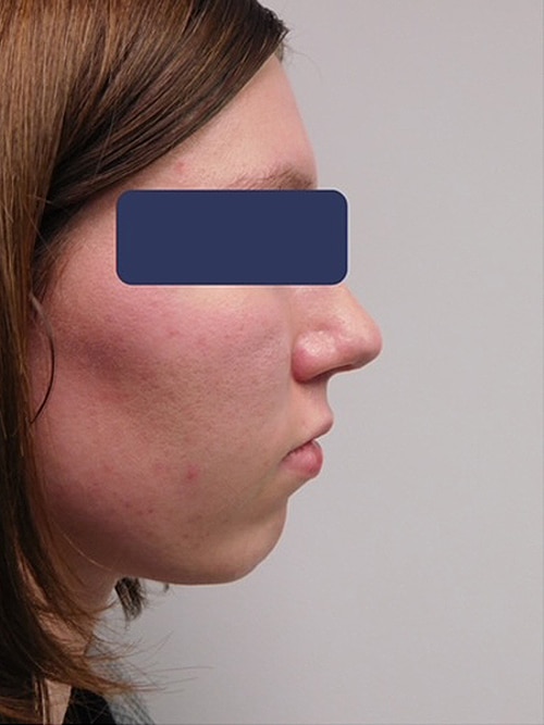 Before Image: Chin Augmentation - right-side