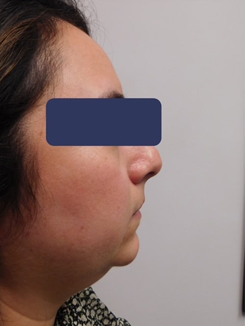 After Image: Chin Augmentation - right-side