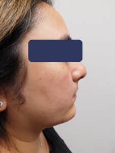 Before Image: Chin Augmentation