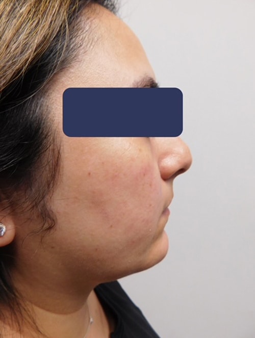 Before Image: Chin Augmentation - right-side