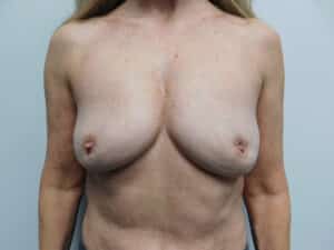 After Image: Complex Breast Issues
