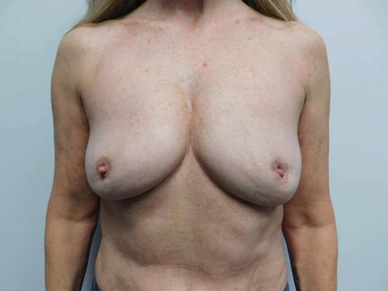 After Image: Complex Breast Issues - front