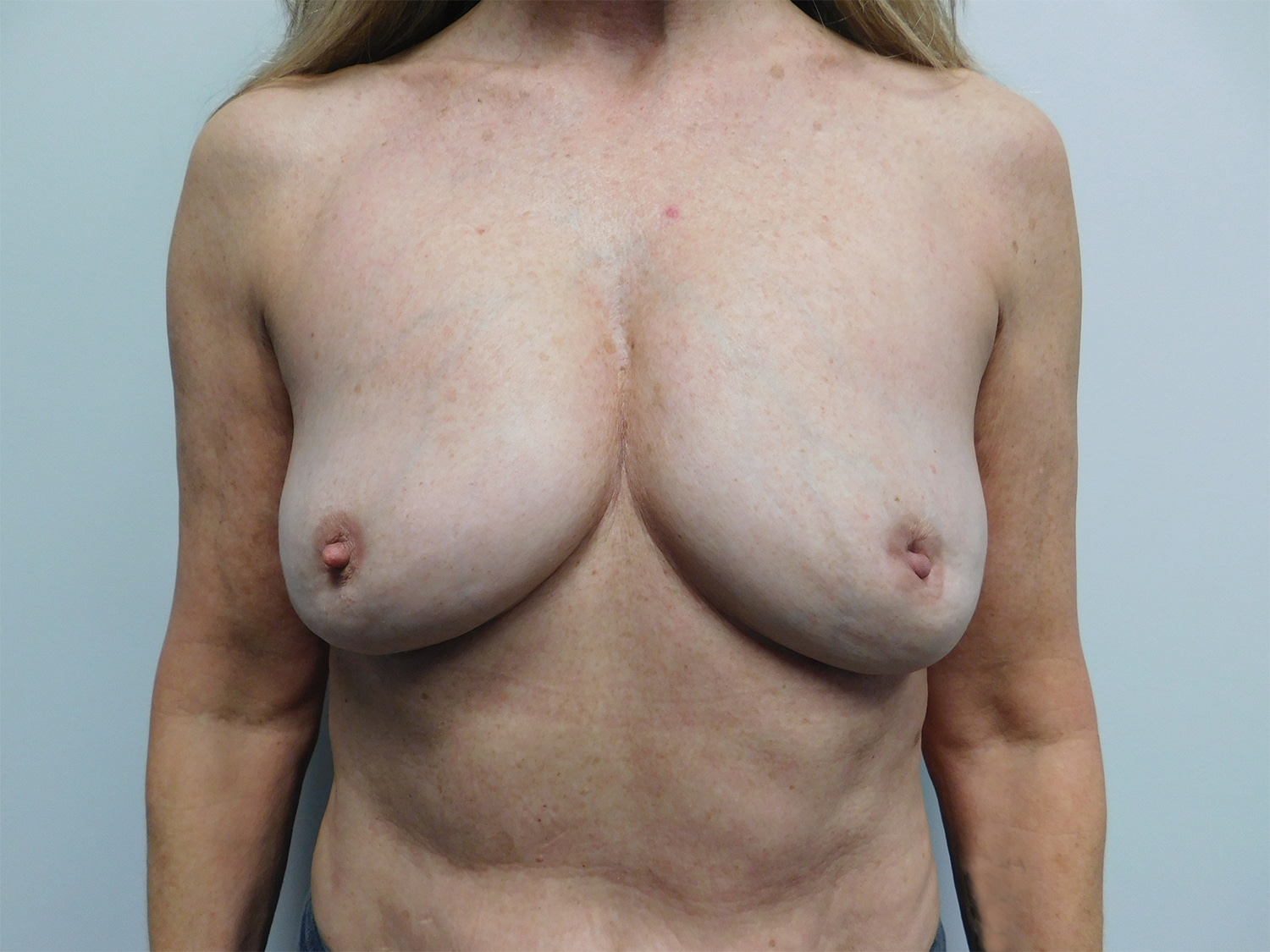 After Image: Complex Breast Issues - front
