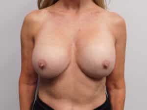 Before Image: Complex Breast Issues