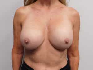 Complex Breast Issues